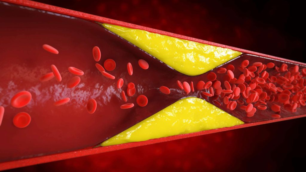 Understanding Your Cholesterol – A Patient Guide
